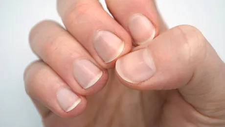 Semnul banal de pe unghia unei femei care s-a dovedit a fi cancer. Medicii i-au spus inițial că sunt sub 1% șanse să fie malign