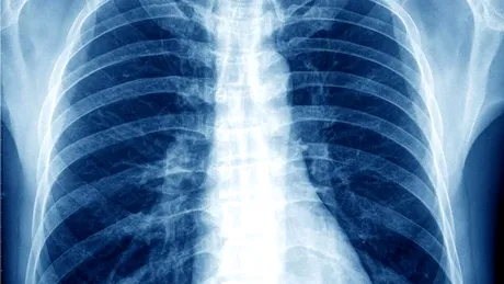 Dr. Cătălin Costovici: „Riscul dezvoltării unui cancer pulmonar este mai mare la persoanele care cumulează mai mulţi factori de risc”