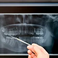 Peste 50% dintre românii cu vârste de peste 40 de ani au lucrări dentare cu plombe cu mercur, tehnică periculoasă, interzisă deja în UE de la începutul anului 2025