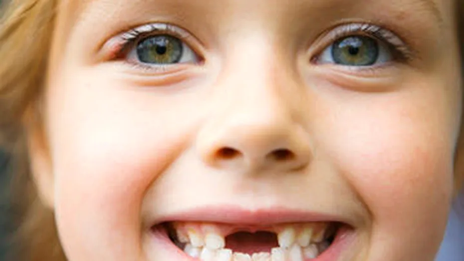 Patru din 10 copii au carii la dinţii definitivi