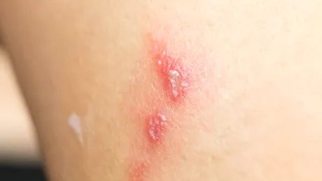 Ectima: cauze, simptome, tratament