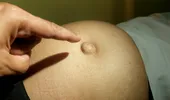 Semnul vizibil pe abdomen care poate trăda o hernie. La început poate să nu doară deloc