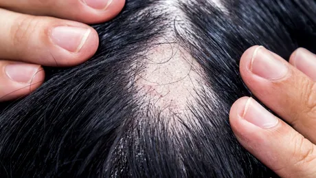 Tratament pentru alopecie – ce funcționează și ce nu?