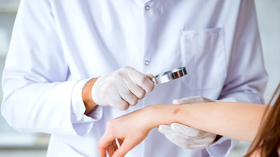 Ectima: de ce apare și cum o tratezi