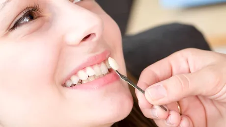 Cât rezistă fațetele dentare? De ce depinde durata lor de viaţă!