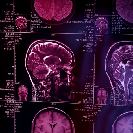 Tremorul mâinilor, problemele de memorie sau schimbările de comportament pot ascunde afecțiuni neurologice. Ce semnale nu ar trebui ignorate