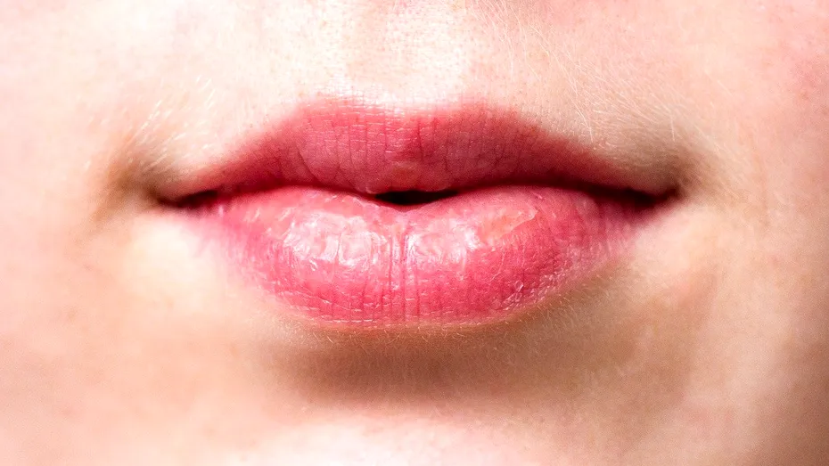 Cheilita angulară: ce este și cum se tratează?