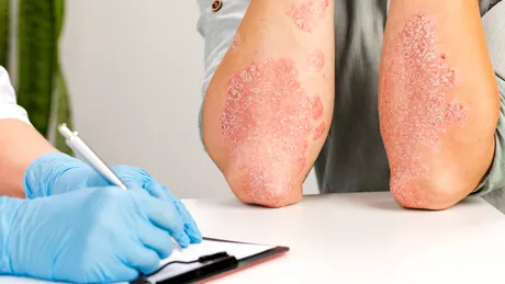 Cele mai întâlnite afecțiuni dermatologice. Bărbații, predispuși la psoriazis și infecții cu transmitere sexuală