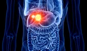 Chemoembolizarea hepatică, soluție pentru tumorile și metastazele din ficat