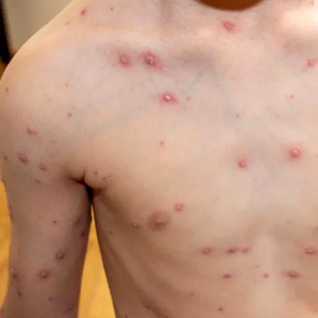 Rujeola, mai aproape de un tratament? Cercetătorii au identificat anticorpi care neutralizează virusul