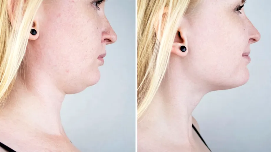 Cum să scapi de gușă în 60 de minute, fără operație. Tehnica de ultimă generație care îți topește grăsimea de sub bărbie