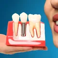 5 preconcepții despre implantul dentar. Ce este adevărat și ce este fals?
