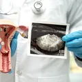 Obiceiul ZILNIC care poate crește riscul de a suferi de cancer la vezică urinară