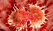 9 semne care pot trăda cancerul în stadii incipiente