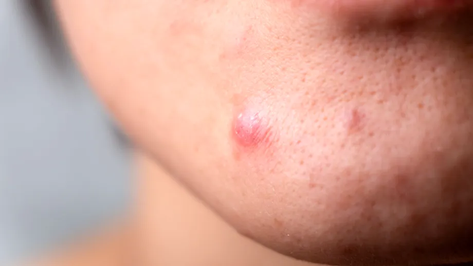 Acneea fungică: cum o recunoști, de ce apare