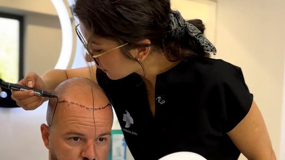 (P) Bărbații și IMPLANTUL de Păr: Ghidul Complet pentru Transplant Capilar în 2025