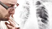 Peste 10.000 de români mor în fiecare an din cauza unui tip de cancer cauzat de fumat. 5 semne că trebuie să mergi la medic