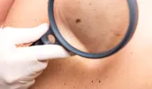 Factori de risc pentru cancerul de piele