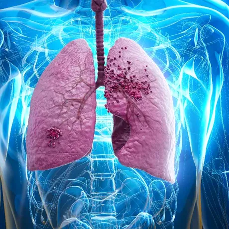 Mituri medicale despre cancerul pulmonar: ce este adevărat și ce nu