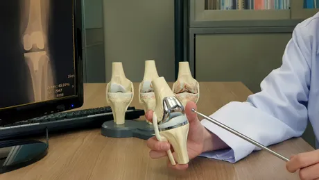 Artroplastia totală de genunchi: „Este indicată în formele avansate de gonartroză”