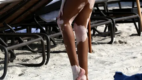 Winnie Harlow, în costum de baie. Cum arată în bikini cel mai sexy model cu vitiligo