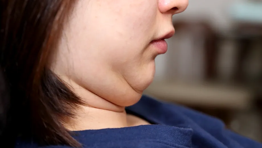 Cum să scapi de bărbia dublă definitiv, fără intervenții estetice