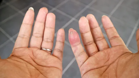 Cum îți dai seama că te-a mușcat un păianjen. Simptome și tratament în caz de mușcătură de păianjen