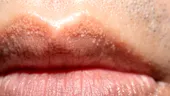 Punctele albe pe buze, penis sau labii nu înseamnă herpes! De ce apar și cum se tratează
