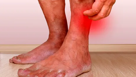 Rana deschisă pe picior, semn de ulcer varicos. URGENT la medic, altfel se ajunge la amputare!