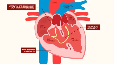 Tetralogia Fallot - cauze, simptome, tratament pentru boala congenitală cardiacă cianotică