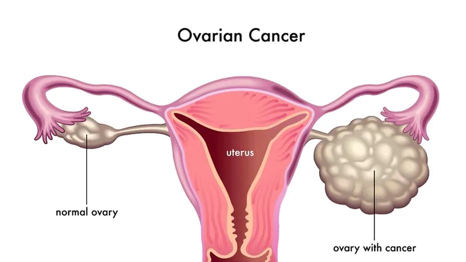 Cancerul ovarian: cauze, simptome, terapii, riscuri