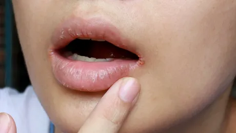 Buze uscate și crăpate? Remediul de casă care le salvează instant