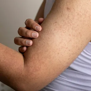 Motivul pentru care apar bubițe roșii pe mâini. 40% din adulți suferă de această boală