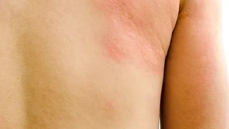 Urticaria cronică: simptome, tratament