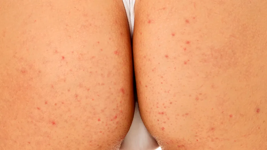 10 remedii naturale pentru coșurile de pe fese