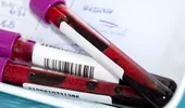 Ce analize de sânge pot arăta daca diabetul a afectat deja rinichii