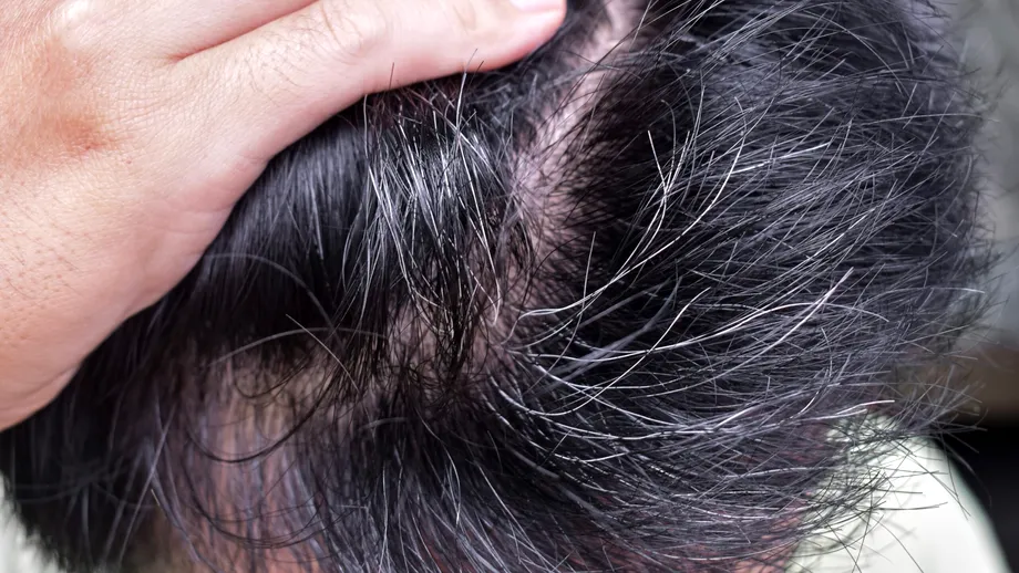 Albirea prematură a părului poate fi reversibilă. Ce spune specialistul