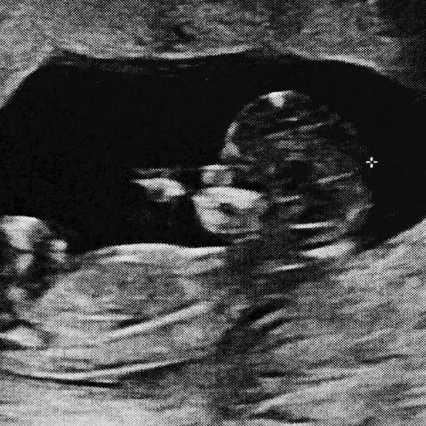 Fenomenul rar al „bebeluşului de piatră”. Rămâne asimptomatic în corp timp de până la 60 de ani. „Fătul mort se află în abdomen și devine calcificat pentru a proteja mama de infecție”