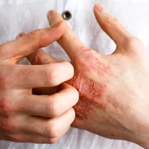 Cum își pot gestiona pacienții cu psoriazis simptomele în sezonul rece. Recomandările medicului dermatolog