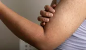 Motivul pentru care apar bubițe roșii pe mâini. 40% din adulți suferă de această boală