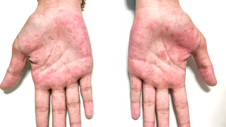 Eczema dishidrotică: ce este, simptome și tratament