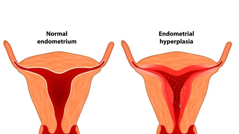 Hiperplazia endometriala: tratament