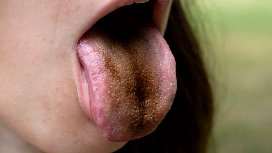 De ce ai „limba neagră păroasă” și ce carențe indică