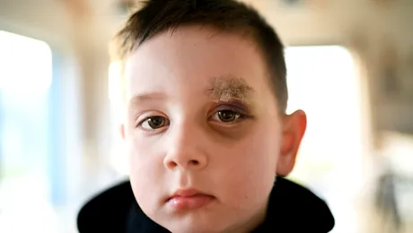 A crezut că fiul ei de 1 an are doar un ochi învinețit de la o mică accidentare. În realitate, micuțul suferea de o boală gravă