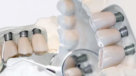 Cel mai ieftin implant dentar – cât costă și cât de sigur este?