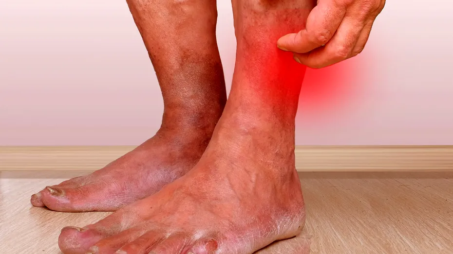Rana deschisă pe picior, semn de ulcer varicos. URGENT la medic, altfel se ajunge la amputare!