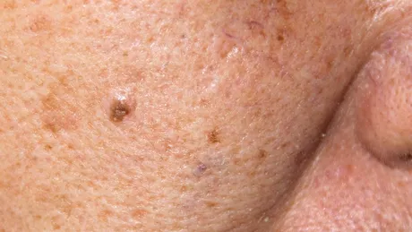 Melasma: ce este, cauze, simptome, tratament şi prevenţie