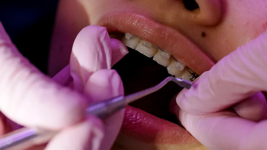 (P) 5 motive pentru care merită să alegi un aparat dentar din safir