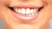 Ce carențe ai dacă îți sângerează gingiile sau îți apar afte