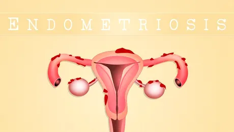 Endometrioza: cauze, simptome, mituri, tratament